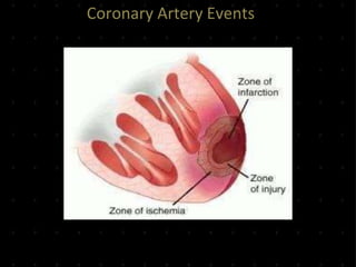 Coronary Artery Events
 