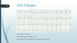 ECG Changes10
Distal LAD Occlusion:
 ST elevation in Leads V1-V6.
 Absence of ST depression in Leads II, III and aVF.
 