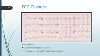 ECG Changes11
RCA Occlusion:
 ST elevation in Lead III>Lead II.
 Presence of reciprocal ST depression in Lead I.
 