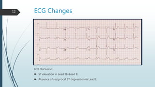 ECG Changes12
LCX Occlusion:
 ST elevation in Lead III=Lead II.
 Absence of reciprocal ST depression in Lead I.
 