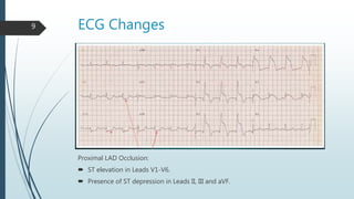 ECG Changes9
Proximal LAD Occlusion:
 ST elevation in Leads V1-V6.
 Presence of ST depression in Leads II, III and aVF.
 