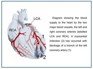 Diagram showing the blood
supply to the heart by the two
major blood vessels, the left and
right coronary arteries (labelled
LCA and RCA). A myocardial
infarction (2) has occurred with
blockage of a branch of the left
coronary artery (1).
 