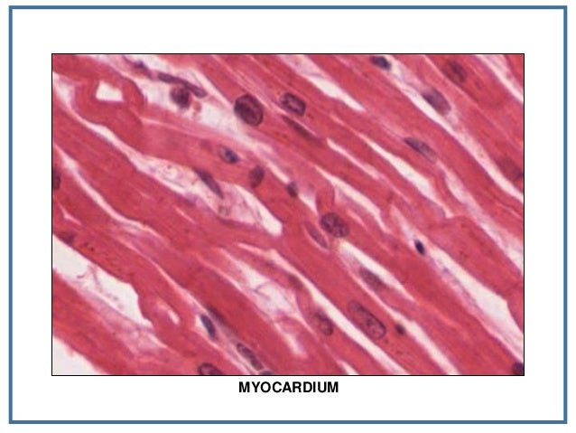 Myocardial infarction