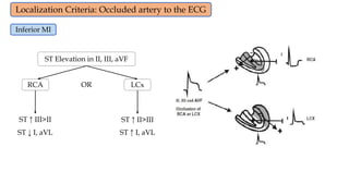 Localizing Mi Myocardial infarction - Medicalbooksvn.wordpress.com