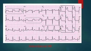 Myocardial infarction (MI) ppt | PPTX