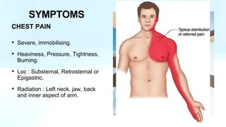 CHEST PAIN
• Severe, immobilising.
• Heaviness, Pressure, Tightness,
Burning.
• Loc : Substernal, Retrosternal or
Epigastric.
• Radiation : Left neck, jaw, back
and inner aspect of arm.
SYMPTOMS
 