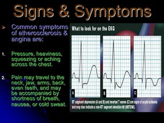 Myocardial Infarction.ppt