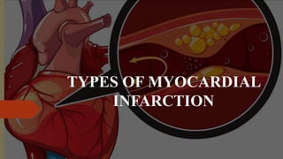 TYPES OF MYOCARDIAL
INFARCTION
 