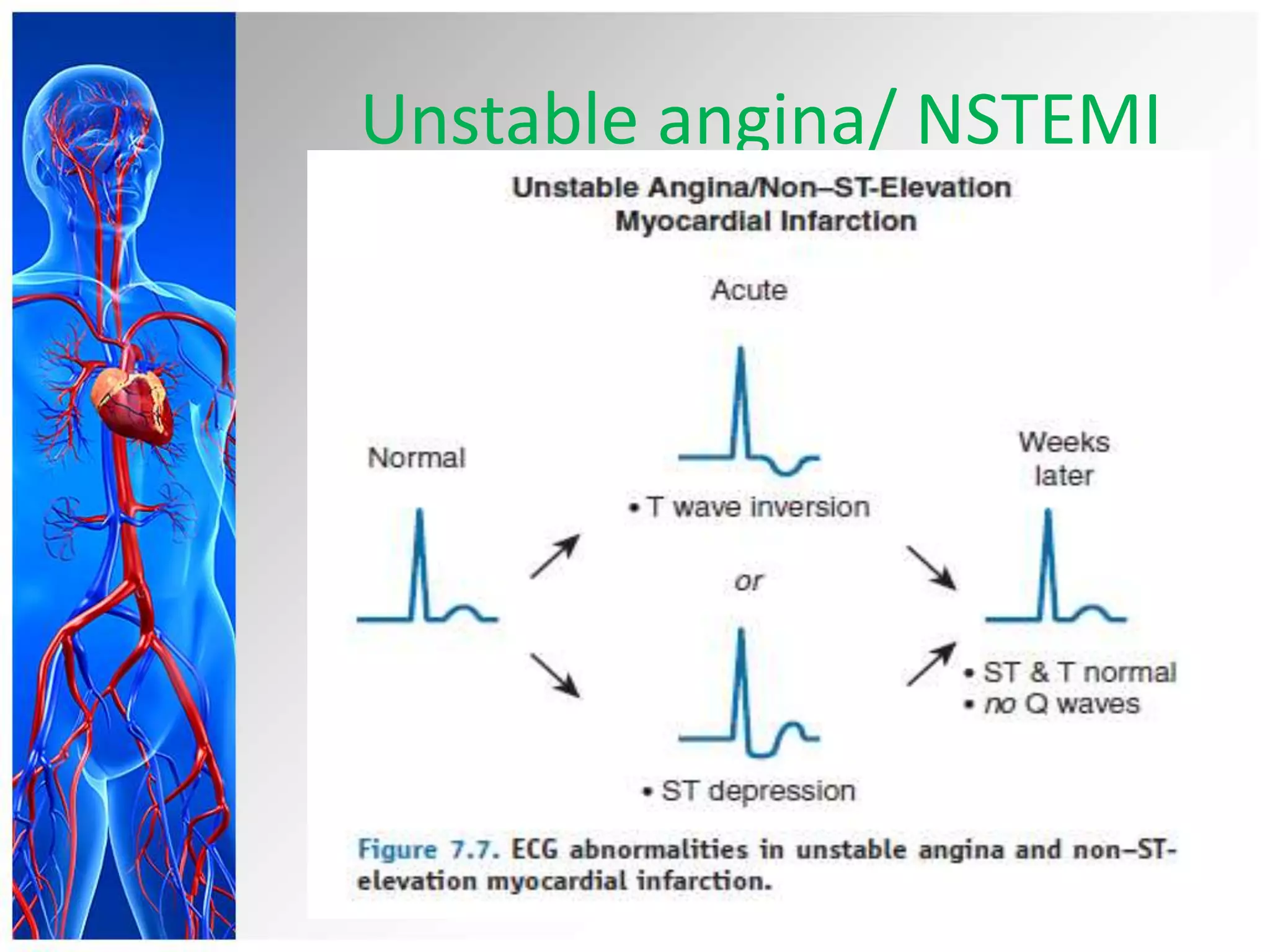 Unstable angina/ NSTEMI
 