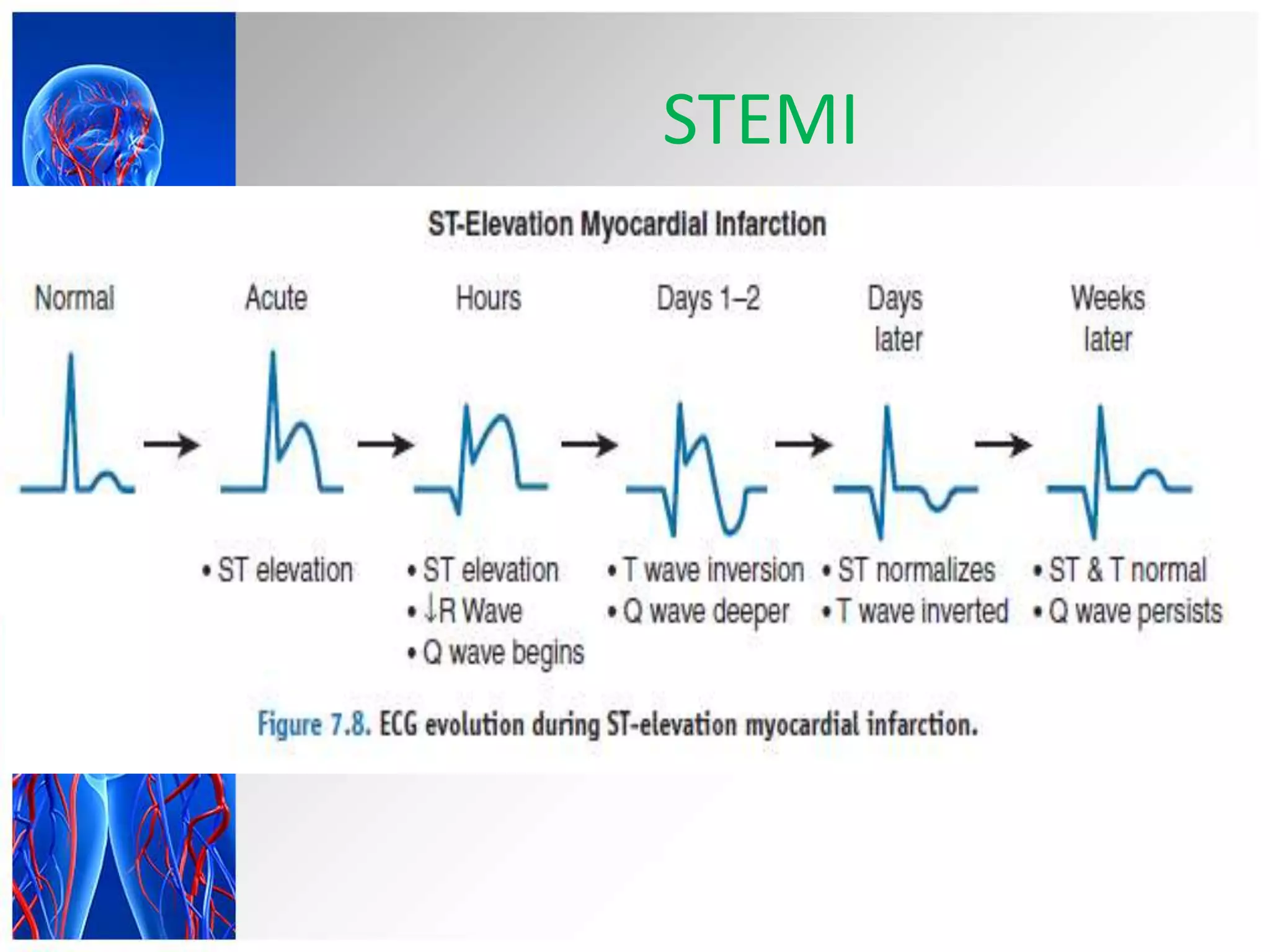 STEMI
 