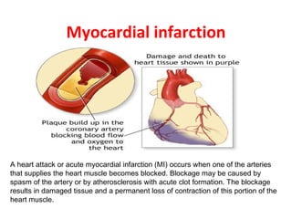 Myocardial infarction A heart attack or acute myocardial infarction (MI) occurs when one of the arteries that supplies the heart muscle becomes blocked. Blockage may be caused by spasm of the artery or by atherosclerosis with acute clot formation. The blockage results in damaged tissue and a permanent loss of contraction of this portion of the heart muscle. 