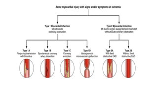 Myocardial infarction [autosaved] | PPTX