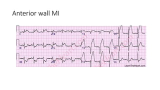 Myocardial infarction [autosaved] | PPTX