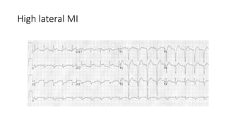 Myocardial infarction [autosaved] | PPTX