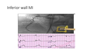 Myocardial infarction [autosaved] | PPTX