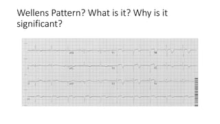 Myocardial infarction [autosaved] | PPTX