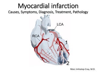 Myocardial infarction
Causes, Symptoms, Diagnosis, Treatment, Pathology
Marc Imhotep Cray, M.D.
 