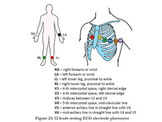 Hints Infarct Presentation on Myocardial_infarction FINAL.ppt