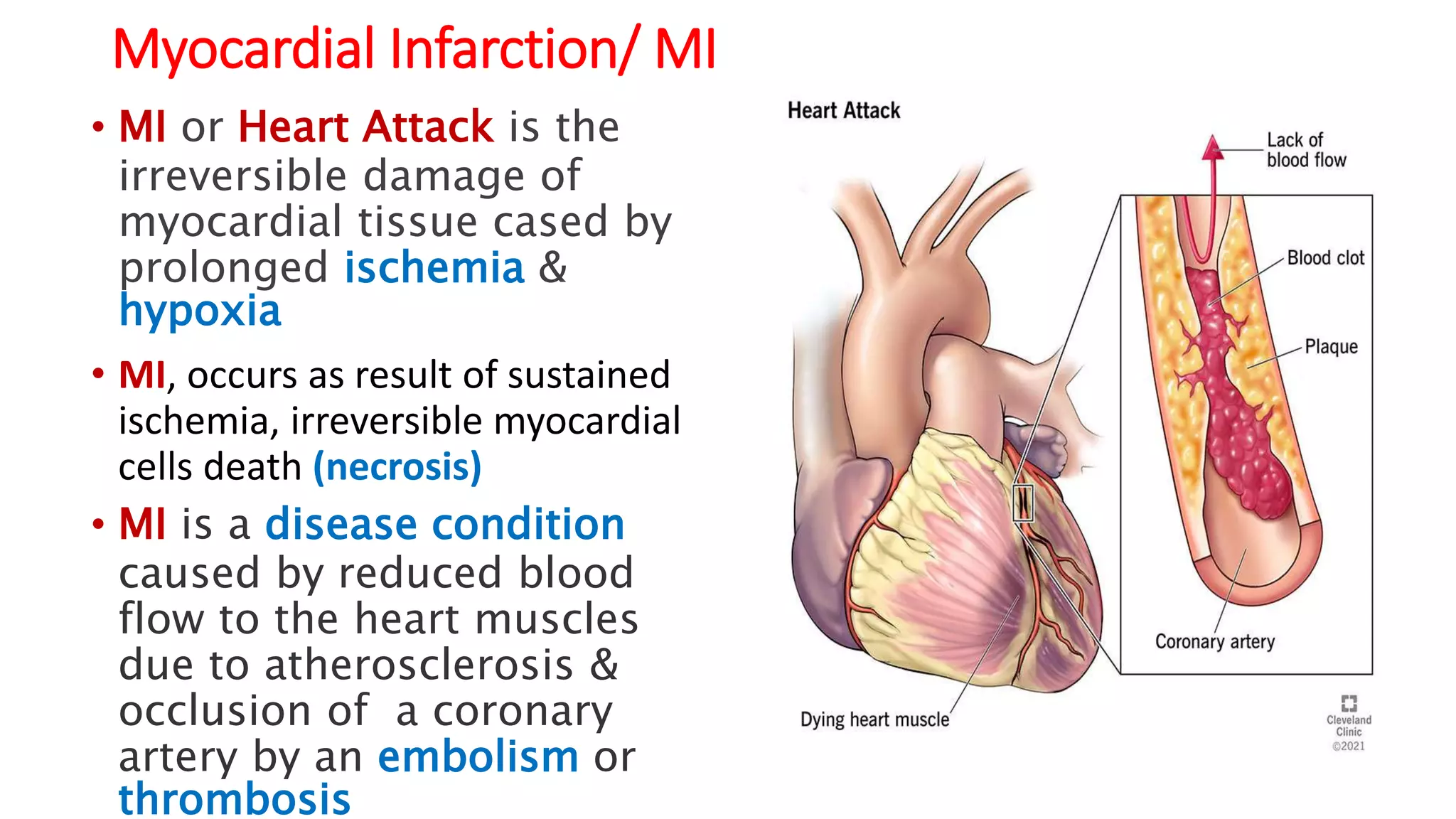 Myocardial Infarction MI [Autosaved].pptx