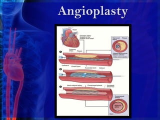 Nitroglycerin to reduce your heart's workload and improveblood flow through the coronary arteries 