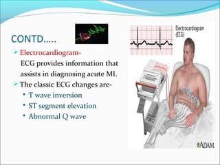 CONTD…..
Electrocardiogram-
ECG provides information that
assists in diagnosing acute MI.
The classic ECG changes are-
 T wave inversion
 ST segment elevation
 Abnormal Q wave
 