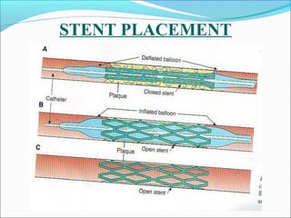 STENT PLACEMENT
 