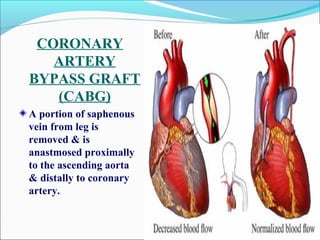 CORONARY
ARTERY
BYPASS GRAFT
(CABG)
A portion of saphenous
vein from leg is
removed & is
anastmosed proximally
to the ascending aorta
& distally to coronary
artery.
 