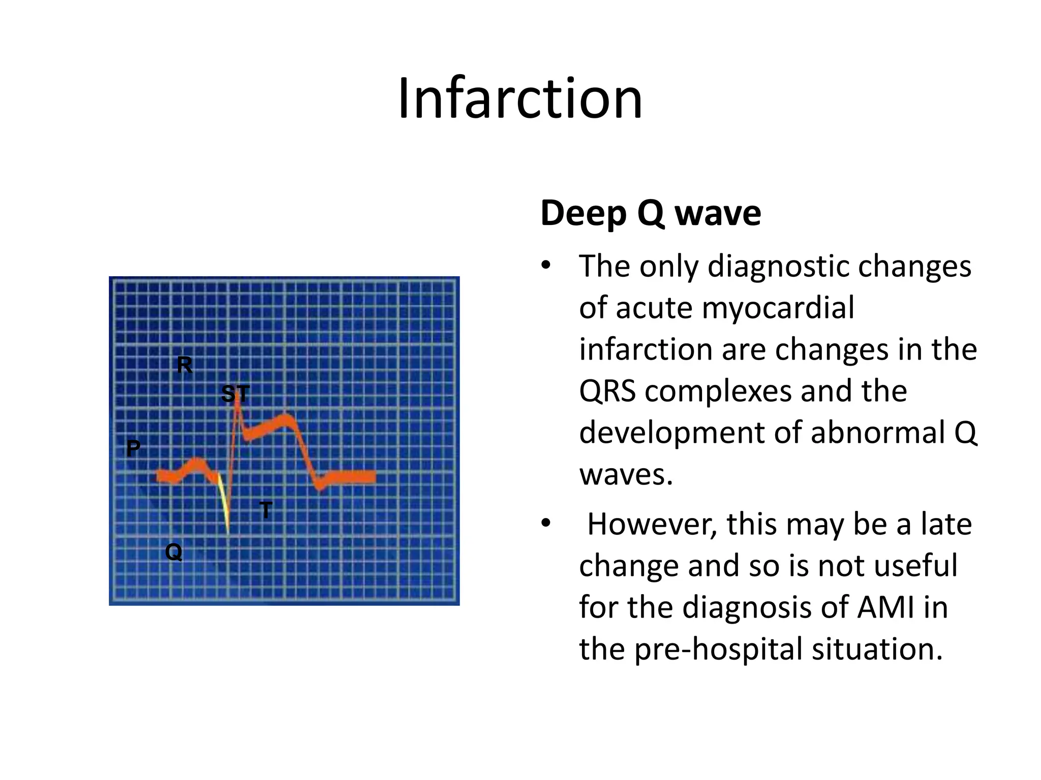 acute coronary syndrome (infarction and ischemia) | PPT | Heart and ...