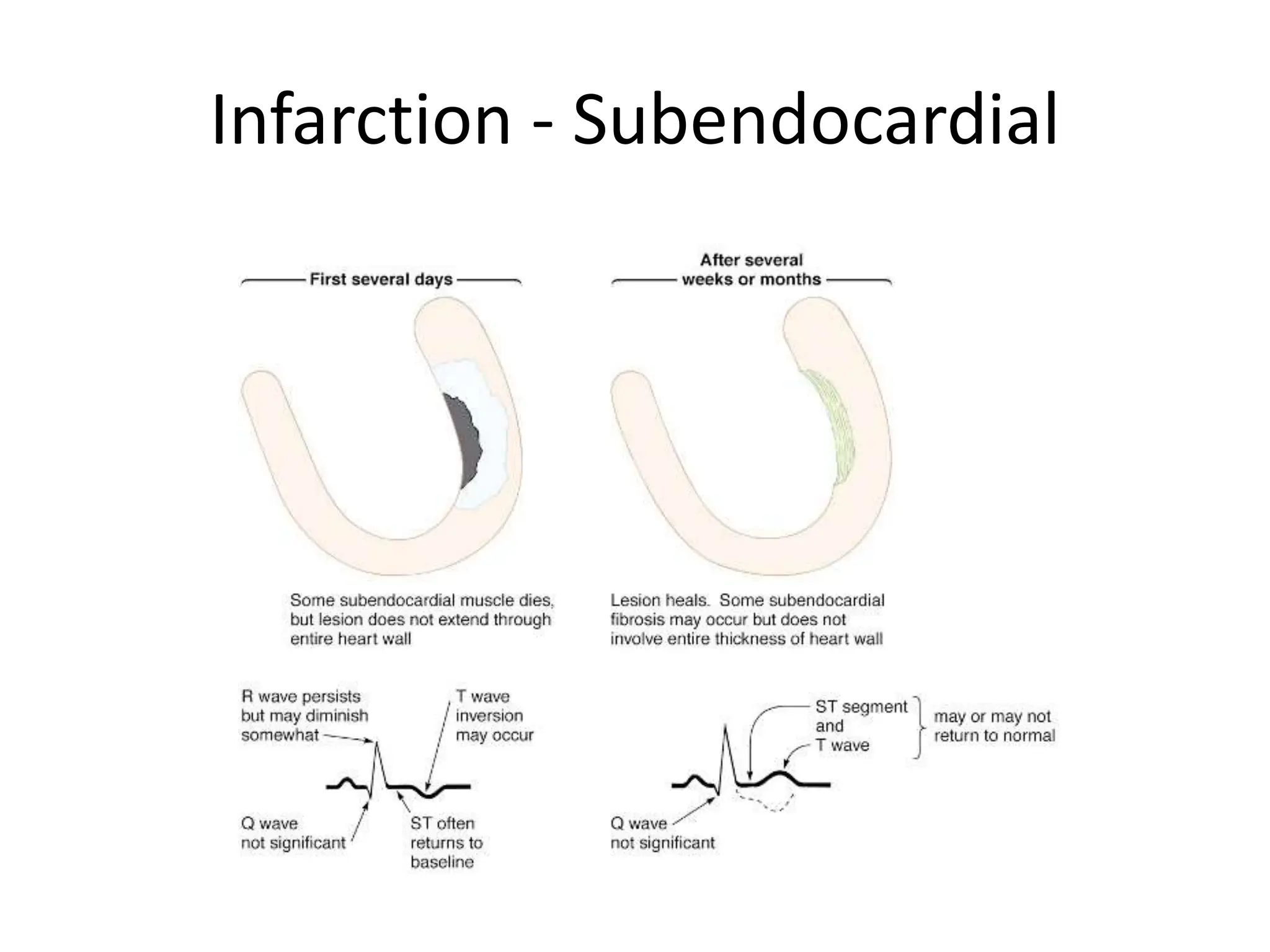 acute coronary syndrome (infarction and ischemia) | PPT | Heart and ...