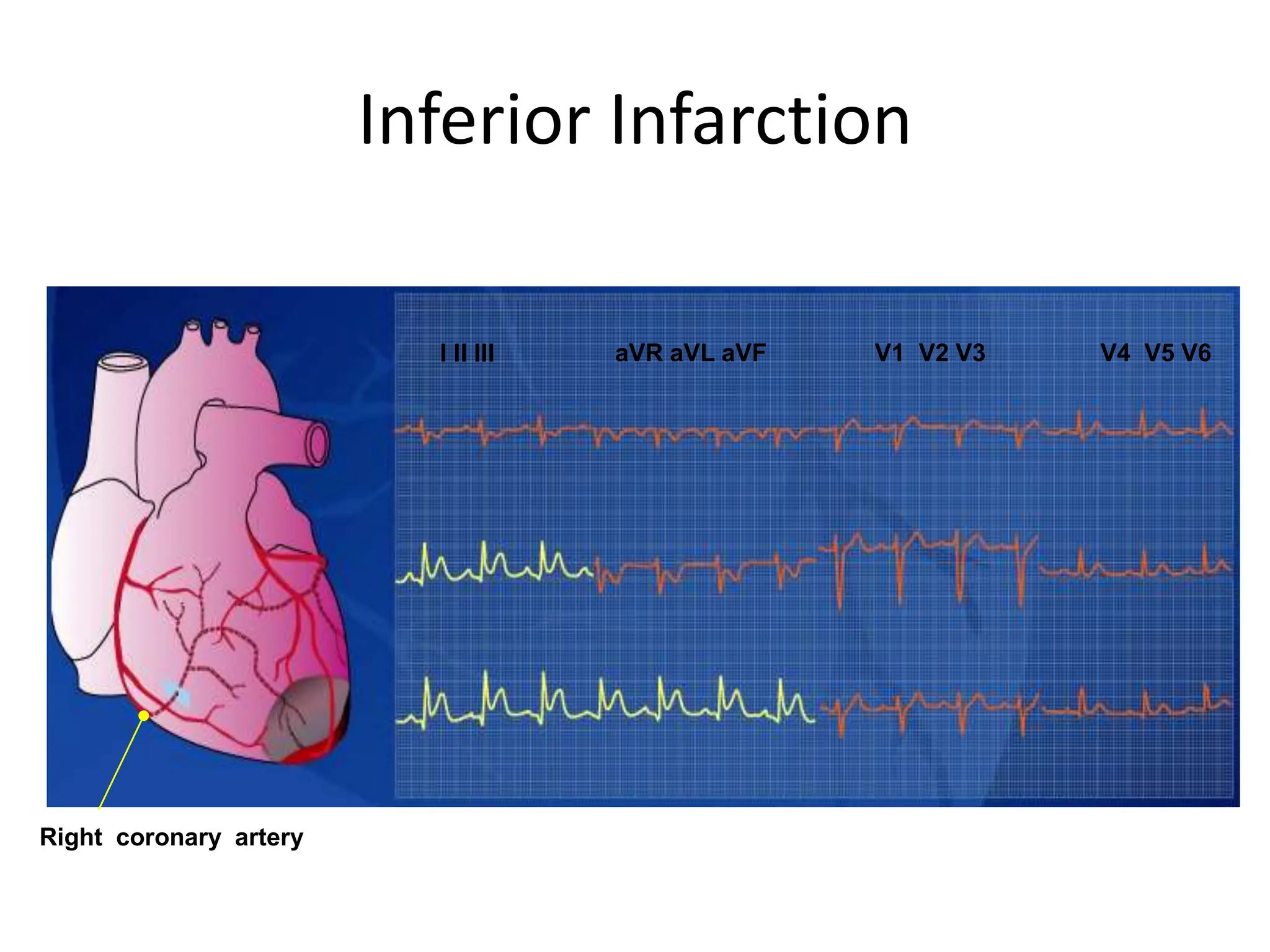 acute coronary syndrome (infarction and ischemia) | PPT | Heart and ...