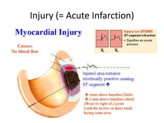 acute coronary syndrome (infarction and ischemia) | PPT