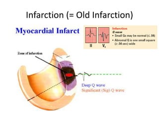 Inferoposterior Infarction acute coronary syndrome (infarction and ischemia) | PPT