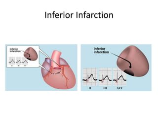 Sss Infarction acute coronary syndrome (infarction and ischemia) | PPT
