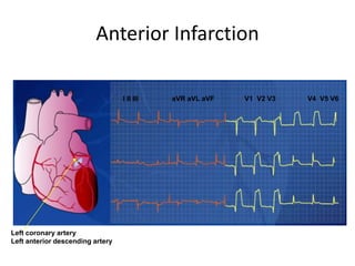 acute coronary syndrome (infarction and ischemia) | PPT