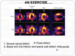 Myocardial viability | PPTX