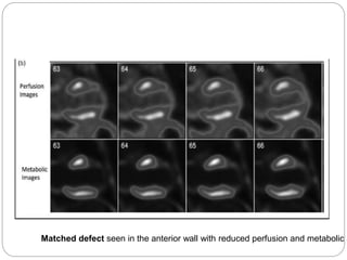 Matched defect seen in the anterior wall with reduced perfusion and metabolic a
 