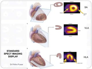STANDARD
SPECT IMAGING
DISPLAY
SA
VLA
HLA
Dr Prithvi Puwar
 