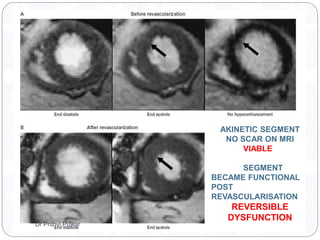 AKINETIC SEGMENT
NO SCAR ON MRI
VIABLE
SEGMENT
BECAME FUNCTIONAL
POST
REVASCULARISATION
REVERSIBLE
DYSFUNCTION
Dr Prithvi Puwar
 