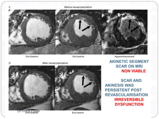 AKINETIC SEGMENT
SCAR ON MRI
NON VIABLE
SCAR AND
AKINESIS WAS
PERSISTENT POST
REVASCULARISATION
IRREVERSIBLE
DYSFUNCTION
Dr Prithvi Puwar
 