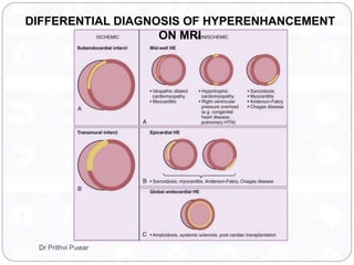 DIFFERENTIAL DIAGNOSIS OF HYPERENHANCEMENT
ON MRI
Dr Prithvi Puwar
 