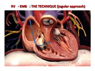 RV - EMB : THE TECHNIQUE (jugular approach)

 