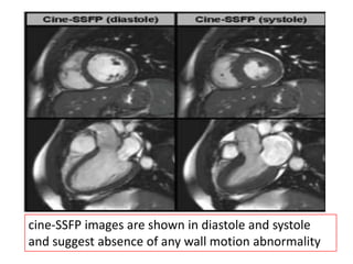 cine-SSFP images are shown in diastole and systole
and suggest absence of any wall motion abnormality

 