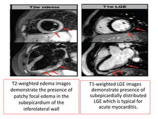 T2-weighted edema images
demonstrate the presence of
patchy focal edema in the
subepicardium of the
inferolateral wall

T1-weighted LGE images
demonstrate presence of
subepicardially distributed
LGE which is typical for
acute myocarditis.

 