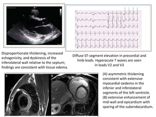Disproportionate thickening, increased
echogenicity, and dyskinesis of the
inferolateral wall relative to the septum;
findings are consistent with tissue edema.

Diffuse ST-segment elevation in precordial and
limb leads. Hyperacute T waves are seen
in leads V2 and V3

(A) asymmetric thickening
consistent with extensive
myocardial oedema in the
inferior and inferolateral
segments of the left ventricle.
(B) extensive enhancement of
mid-wall and epicardium with
sparing of the subendocardium.

 