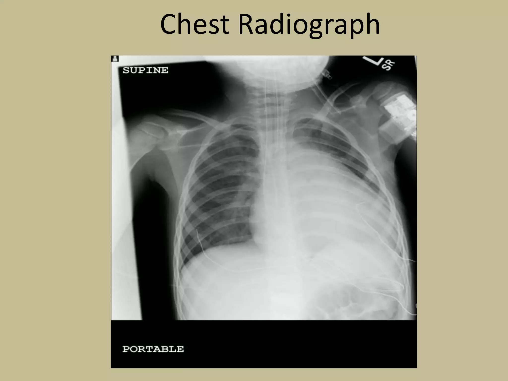 Chest Radiograph

 