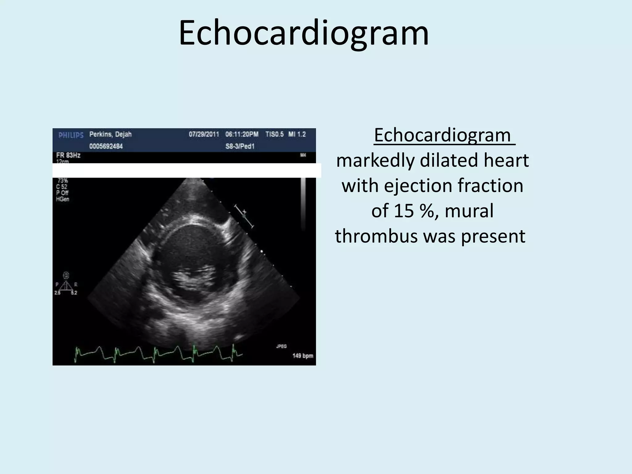Echocardiogram
Echocardiogram
markedly dilated heart
with ejection fraction
of 15 %, mural
thrombus was present

 