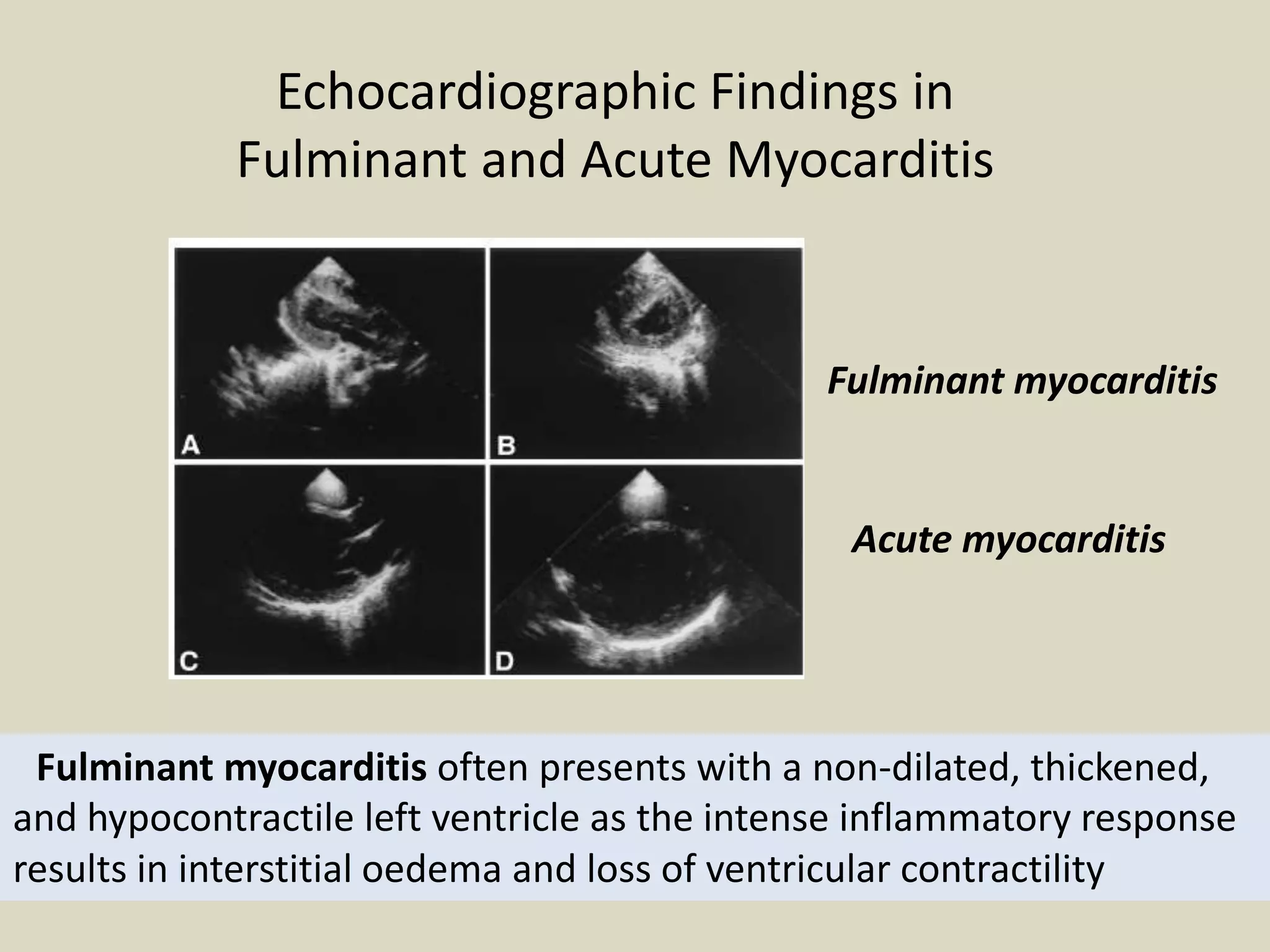 Echocardiographic Findings in
Fulminant and Acute Myocarditis

Fulminant myocarditis

Acute myocarditis

Fulminant myocarditis often presents with a non-dilated, thickened,
and hypocontractile left ventricle as the intense inflammatory response
results in interstitial oedema and loss of ventricular contractility

 