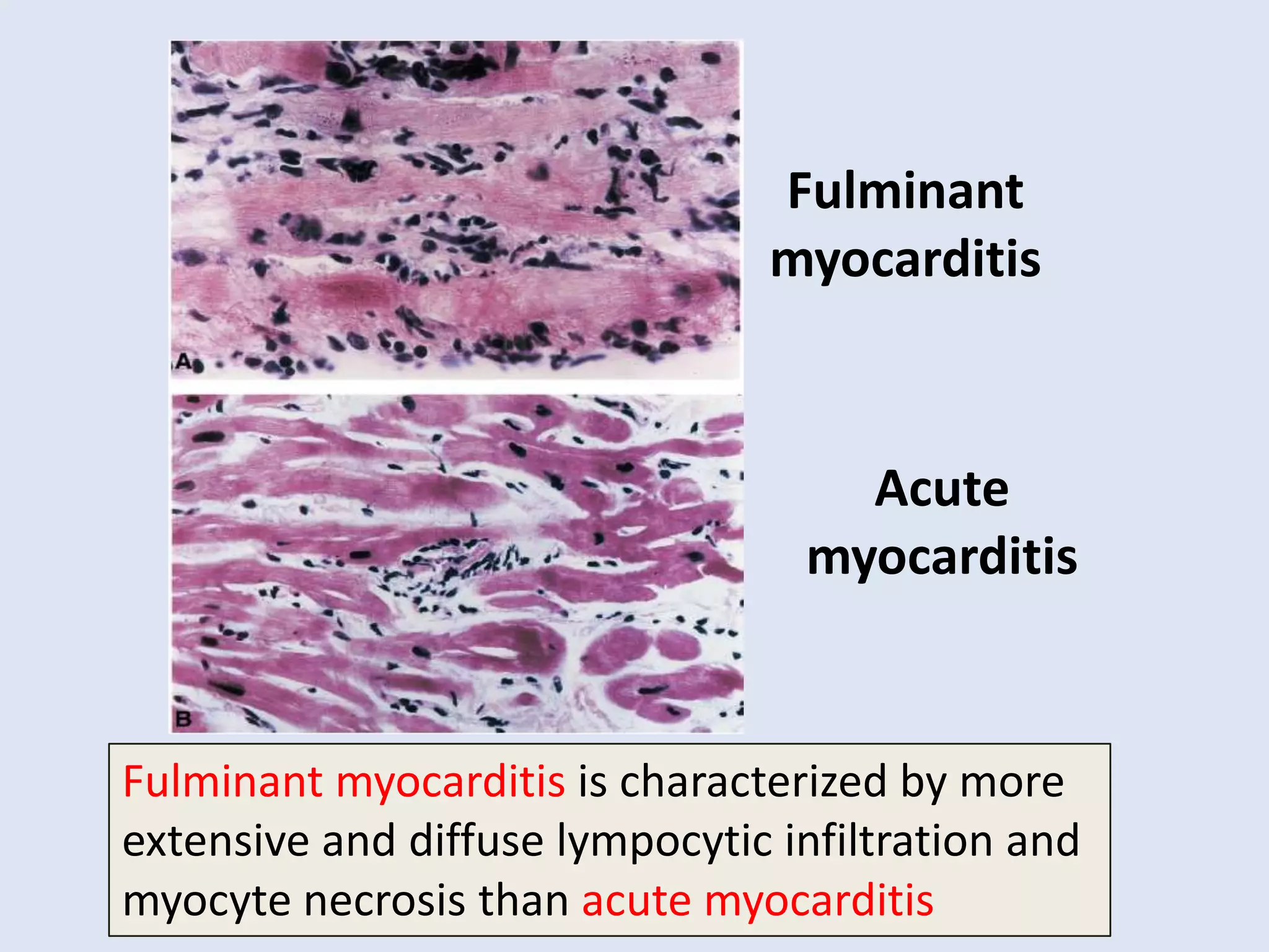 Fulminant
myocarditis

Acute
myocarditis

Fulminant myocarditis is characterized by more
extensive and diffuse lympocytic infiltration and
myocyte necrosis than acute myocarditis

 