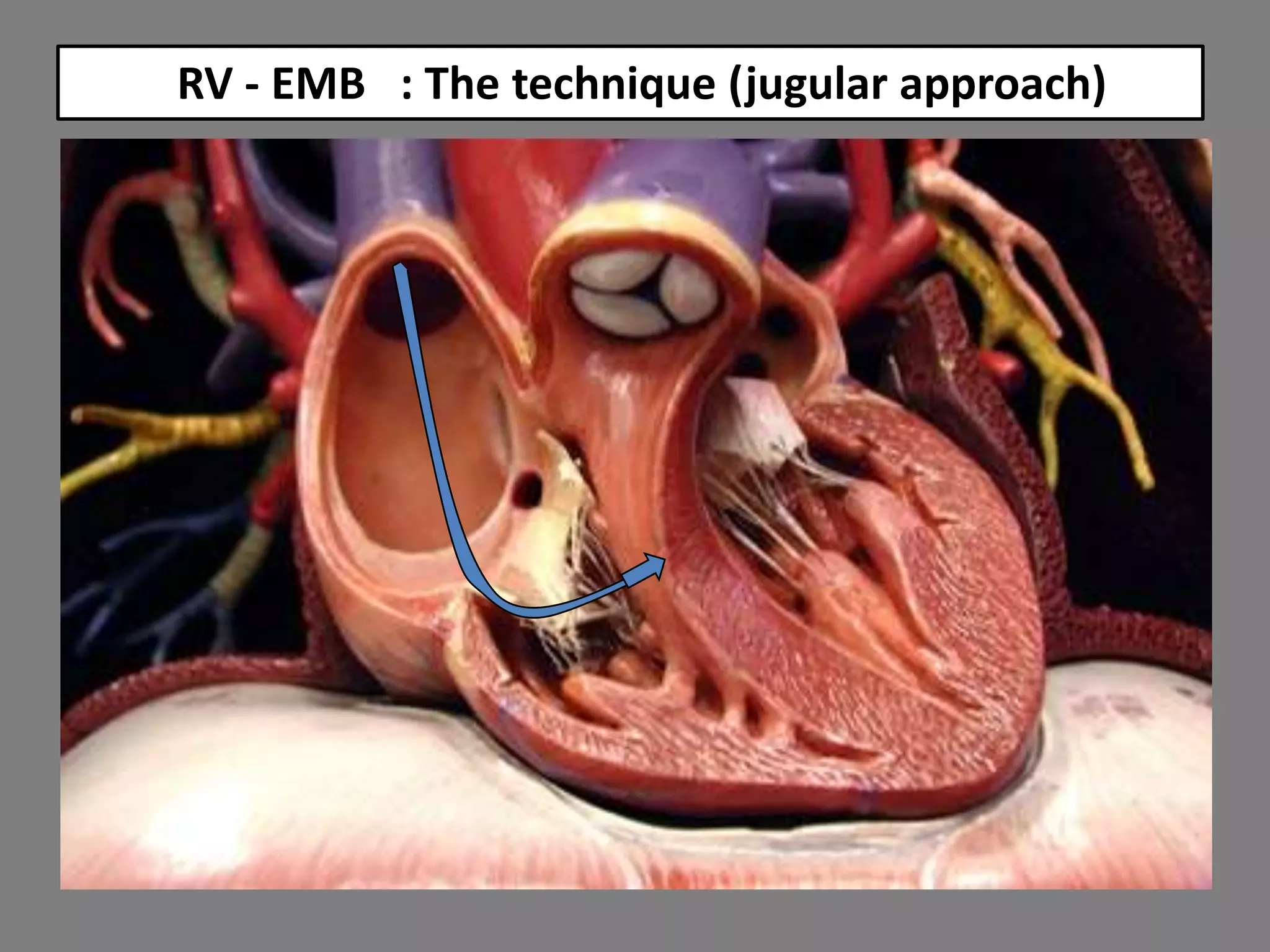 RV - EMB : The technique (jugular approach)

 