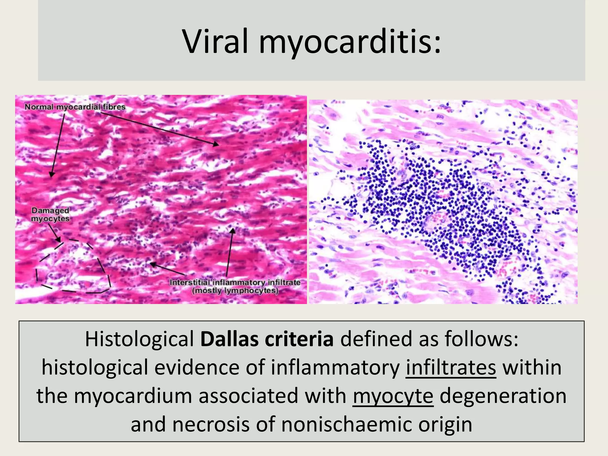 Viral myocarditis:

Histological Dallas criteria defined as follows:
histological evidence of inflammatory infiltrates within
the myocardium associated with myocyte degeneration
and necrosis of nonischaemic origin

 